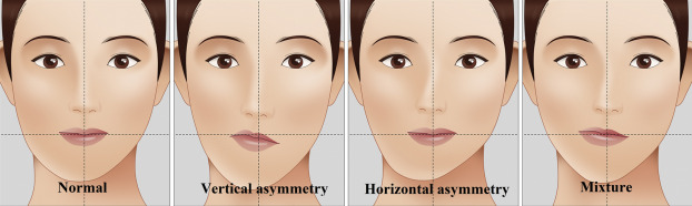 How To Fix Facial Asymmetry What Can You Do